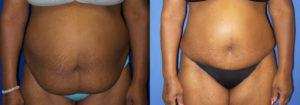 Schoemann-Plastic-Surgery_Encinitas_tummy-tuck-patient-2-1