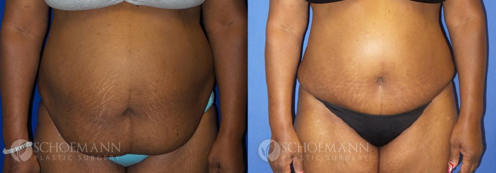 Schoemann-Plastic-Surgery_Encinitas_tummy-tuck-patient-2-1