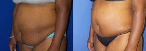 Schoemann-Plastic-Surgery_Encinitas_tummy-tuck-patient-2-2