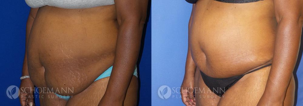 Schoemann-Plastic-Surgery_Encinitas_tummy-tuck-patient-2-2