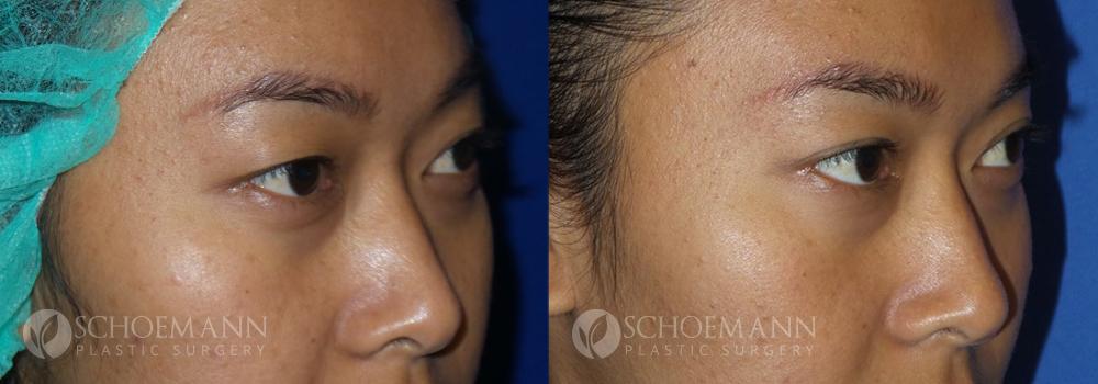 Schoemann-Plastic-Surgery_Encinitas_eyelid-surgery-patient-2-2