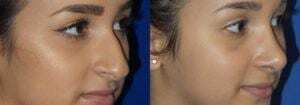 Schoemann-Plastic-Surgery_Encinitas_rhinoplasty-patient-1-2