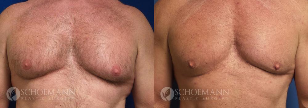 Schoemann-Plastic-Surgery_Encinitas_gynecomastia-patient-2-1