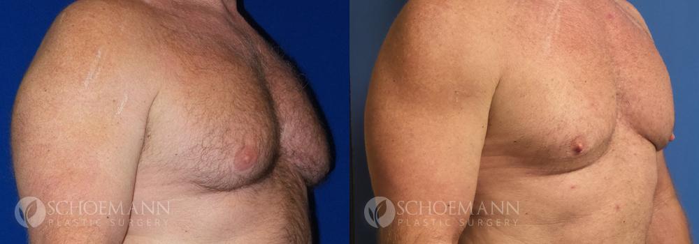 Schoemann-Plastic-Surgery_Encinitas_gynecomastia-patient-2-2