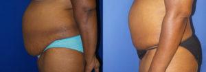 Schoemann-Plastic-Surgery_Encinitas_tummy-tuck-patient-2-3