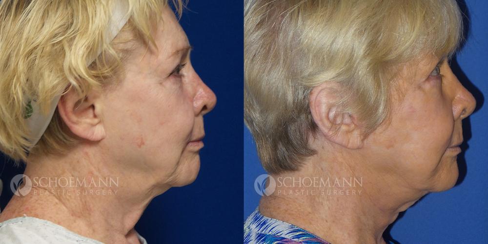 Schoemann-Plastic-Surgery_Encinitas_facelift-patient-1-3