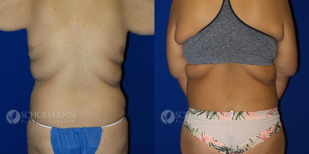 Schoemann-Plastic-Surgery_Encinitas_after-weight-loss-patient-1-3