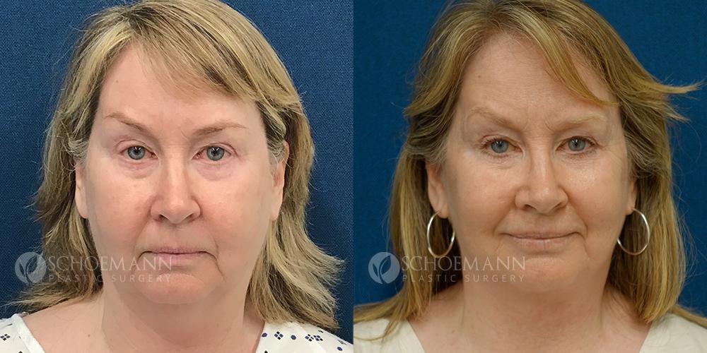 Schoemann-Plastic-Surgery_Encinitas_facelift-patient-4-1