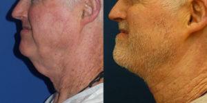 Schoemann-Plastic-Surgery_Encinitas_neck-lift-patient-1-2