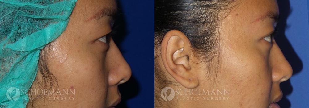 Schoemann-Plastic-Surgery_Encinitas_eyelid-surgery-patient-2-3