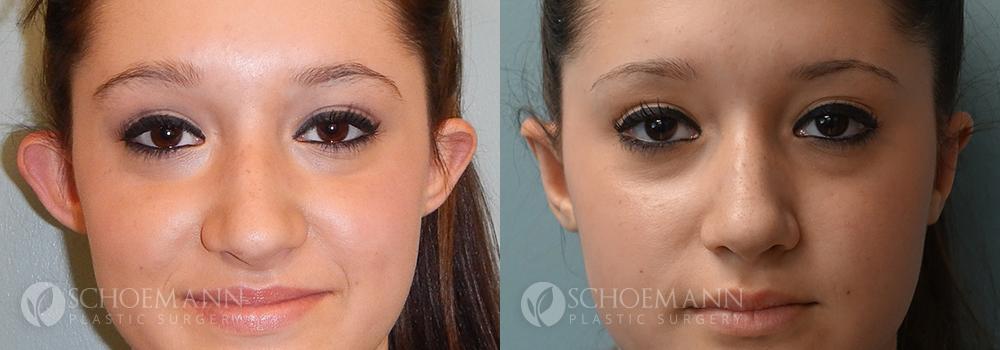 Schoemann-Plastic-Surgery_Encinitas_ear-surgery-patient-1-1