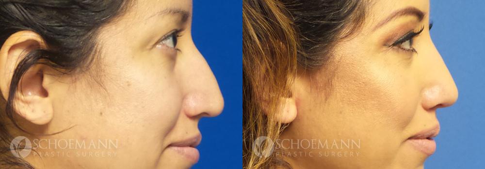 Schoemann Plastic Surgery Rhinoplasty Patient 2-3