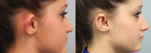 Schoemann-Plastic-Surgery_Encinitas_ear-surgery-patient-1-2