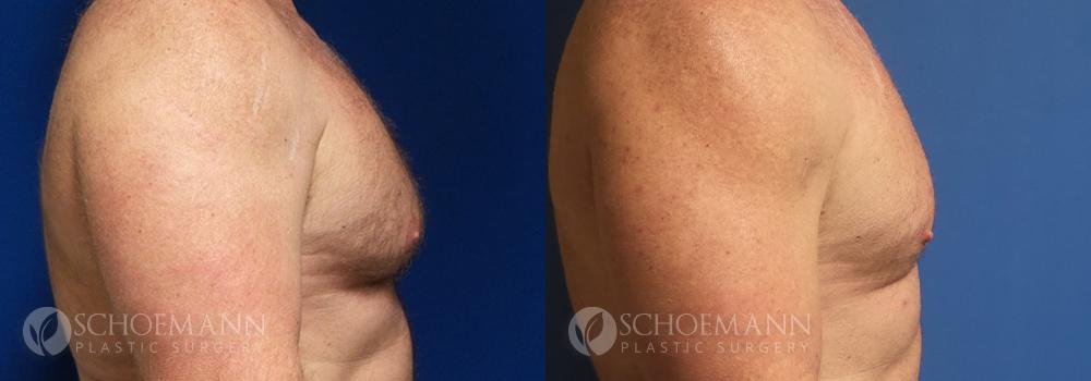 Schoemann-Plastic-Surgery_Encinitas_gynecomastia-patient-2-3