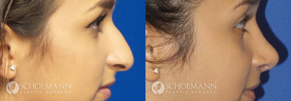 Rhinoplasty Patient 1-3