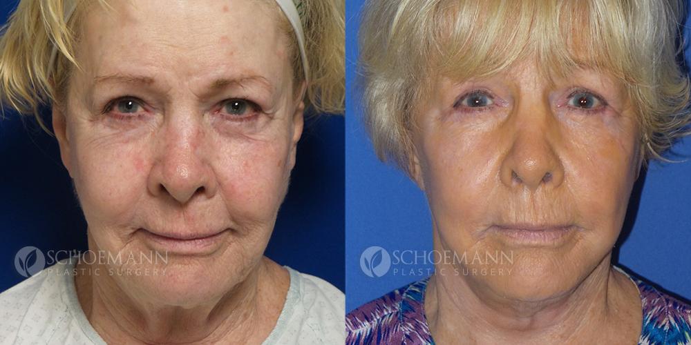 Schoemann-Plastic-Surgery_Encinitas_facelift-patient-1-1