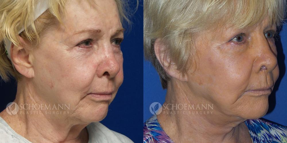 Schoemann-Plastic-Surgery_Encinitas_facelift-patient-1-2