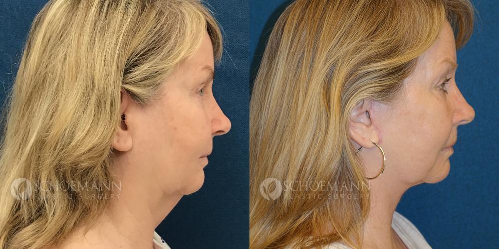 Schoemann-Plastic-Surgery_Encinitas_facelift-patient-4-3