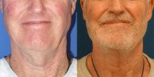 Schoemann-Plastic-Surgery_Encinitas_neck-lift-patient-1-1