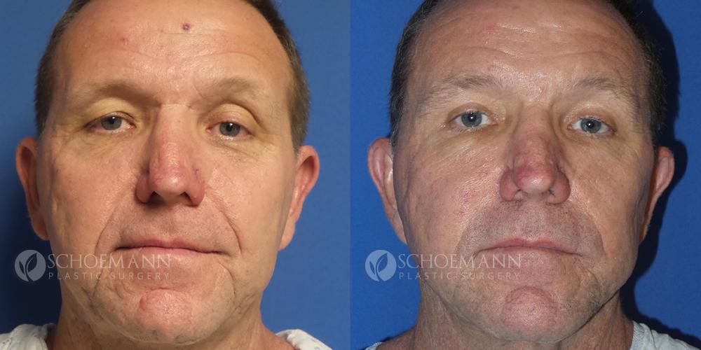 Schoemann-Plastic-Surgery_Encinitas_facelift-patient-2-1