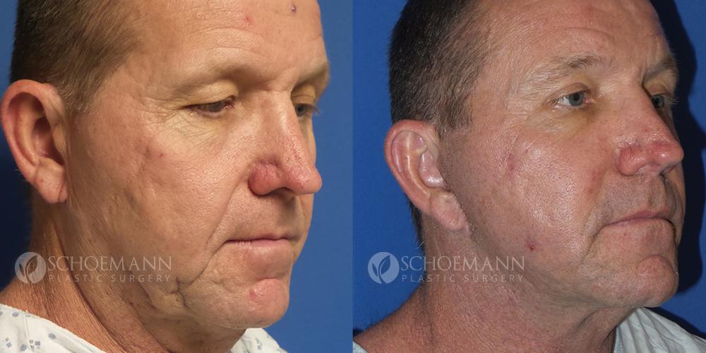 Schoemann-Plastic-Surgery_Encinitas_facelift-patient-2-2