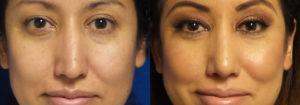 Schoemann-Plastic-Surgery_Encinitas_rhinoplasty-patient-2-1