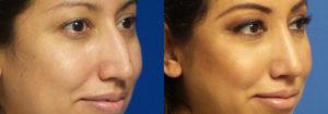 Schoemann-Plastic-Surgery_Encinitas_rhinoplasty-patient-2-2