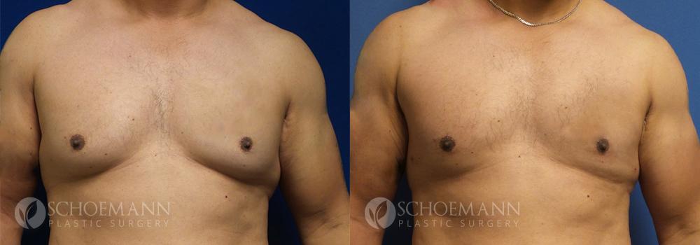 Schoemann-Plastic-Surgery_Encinitas_gynecomastia-patient-1-1