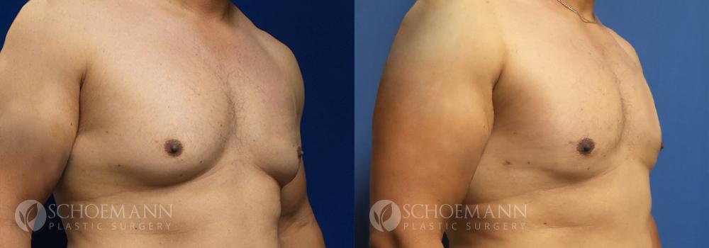 Schoemann-Plastic-Surgery_Encinitas_gynecomastia-patient-1-2