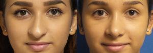 Schoemann-Plastic-Surgery_Encinitas_rhinoplasty-patient-1-1