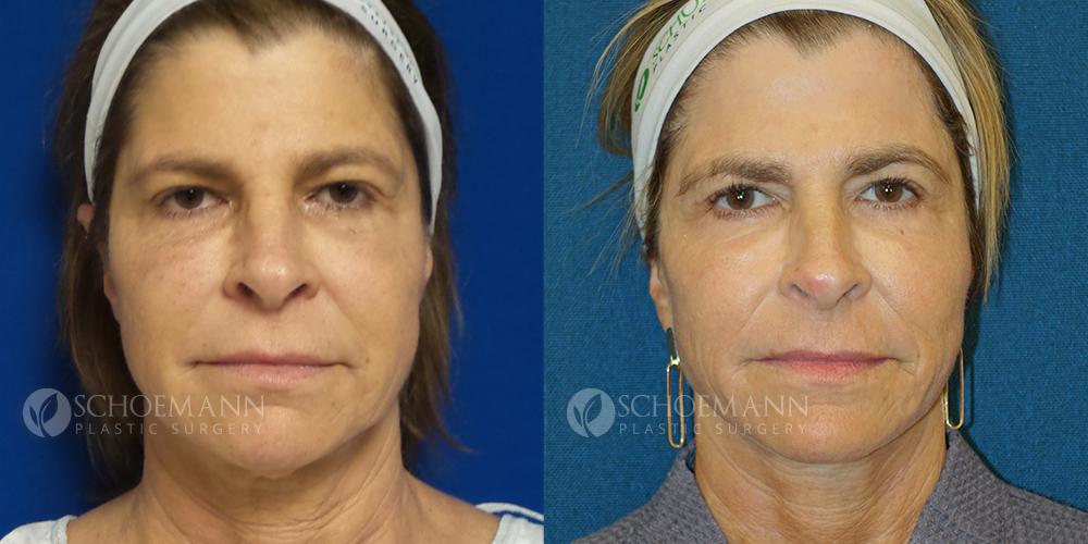 Schoemann-Plastic-Surgery_Encinitas_facelift-patient-3-1