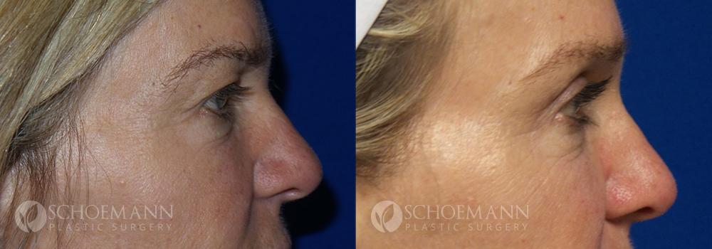 Schoemann-Plastic-Surgery_Encinitas_eyelid-surgery-patient-1-3