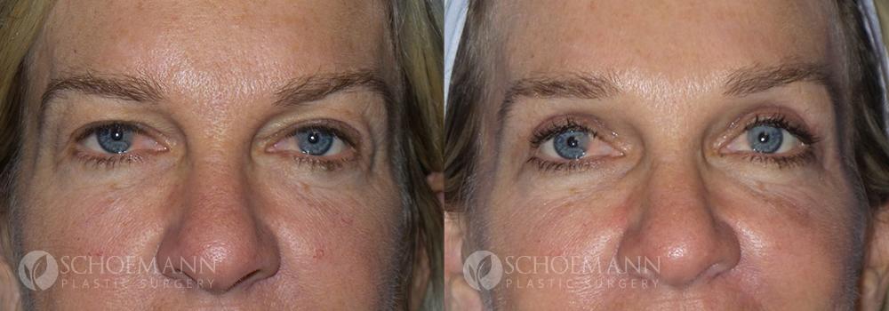 Schoemann-Plastic-Surgery_Encinitas_eyelid-surgery-patient-1-1