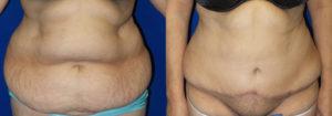 Schoemann-Plastic-Surgery_Encinitas_tummy-tuck-patient-1-1