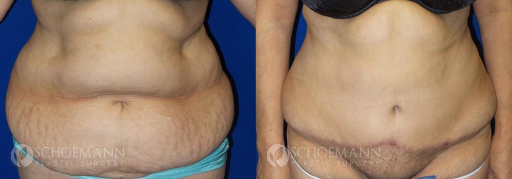 Schoemann-Plastic-Surgery_Encinitas_tummy-tuck-patient-1-1