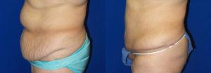 Schoemann Plastic Surgery Tummy Tuck Patient 1-2