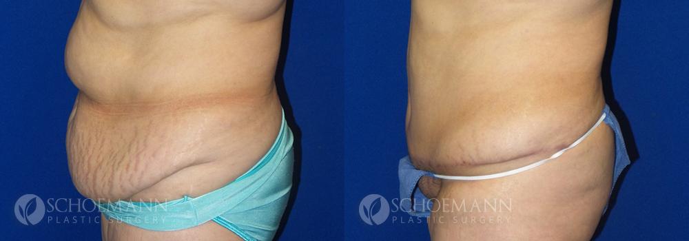 Schoemann Plastic Surgery Tummy Tuck Patient 1-2