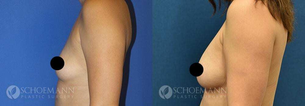 schoemann-plastic-surgery-encinitas-breast-augmentation-patient-11-3-censored